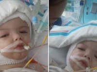 生まれつき頭部が結合していた双子の赤ちゃん、無事に分離手術が成功