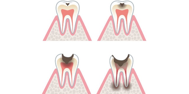 エナメル質が溶けた虫歯