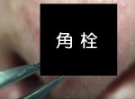 【グロ注意】鼻の角栓を引き抜くだけの動画がクセになる！？