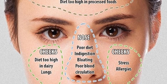 ニキビや吹き出物のできる位置でわかるあなたの健康状態とその解消法（英研究）