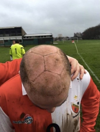 薄毛男性のくっきりすぎるヘディング跡が話題に　「動くサッカーボール頭だな」