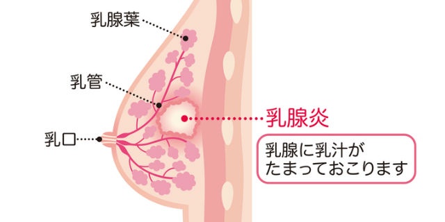 乳腺炎の解説