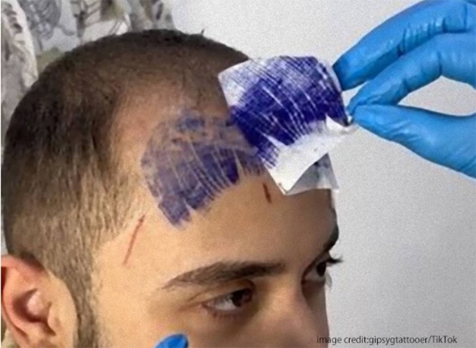 後退した前髪をタトゥーでごまかそうとした男性、その仕上がりはこちらです