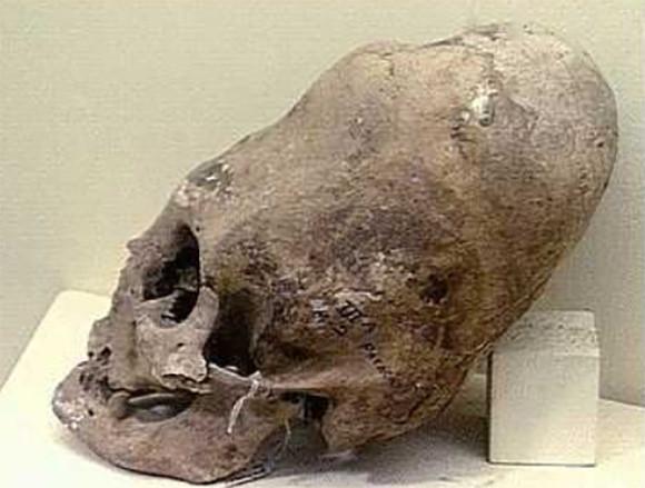 ペルーで発見された長く変形した頭蓋骨は「人工頭蓋変形」ではなく先天的な遺伝子異常によるもの。最新のDNA検査結果が発表される。