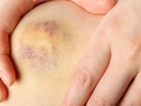 あざができやすい人の特徴って？