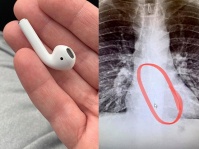 就寝中にワイヤレスイヤホン「AirPods」を飲み込んでしまった男性のレントゲン写真