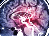 脳を半分切除しても普通に生活を送れる人がいる。その理由が明らかに（米研究）