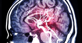 脳を半分切除しても普通に生活を送れる人がいる。その理由が明らかに（米研究）