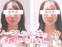 驚きの即効性。脱マスク時代に怯えるアラサー編集部員が美容施術「エアバリ」を体験